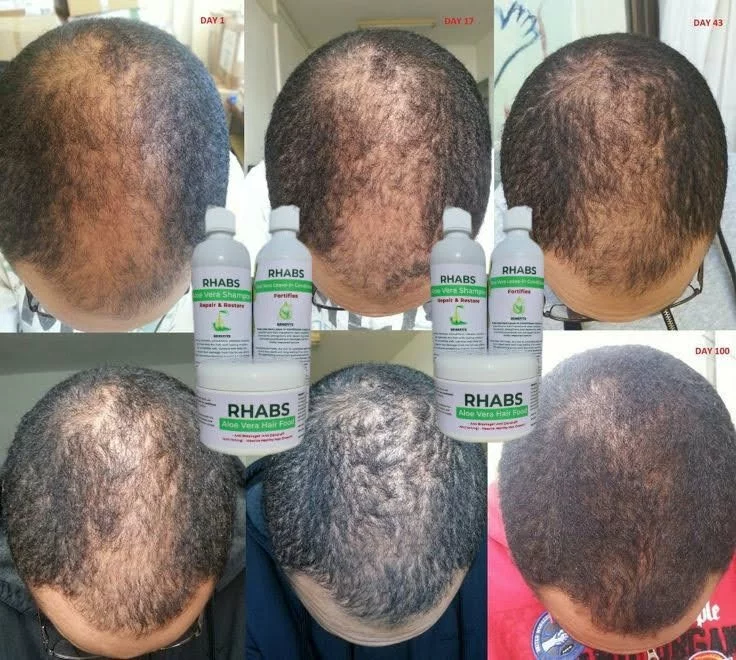 RHABS Aloe Vera Hair Growth & Baldness Treatment Set