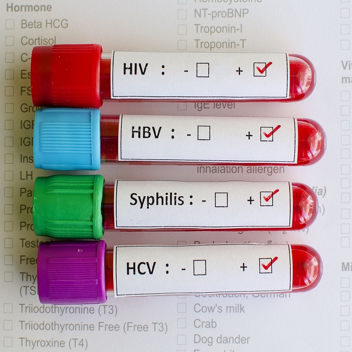 Dlabs - STIs Screen (HBV, HCV, Retroscreen 1&2, VDRL)