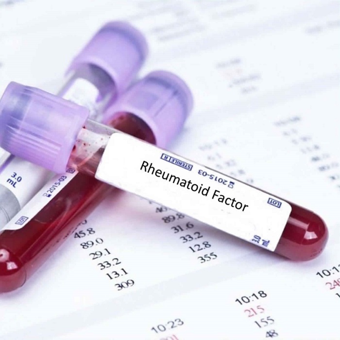 Dlabs - Rheumatoid Factor Testing
