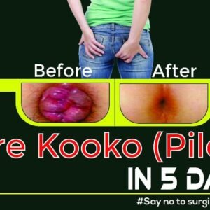 Natural Piles (Hemorrhoids) Remedy